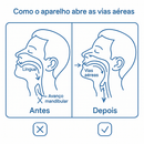 Protetor Bucal Anti-Ronco e Bruxismo
